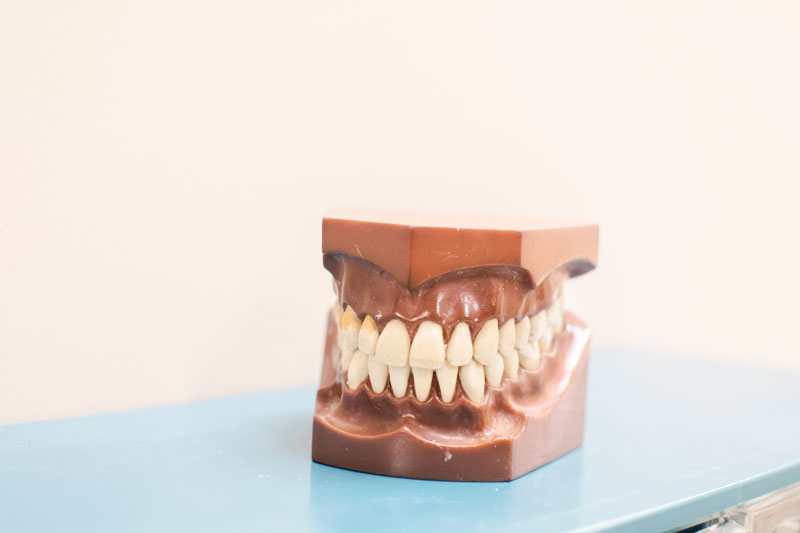 Full Mouth Reconstruction